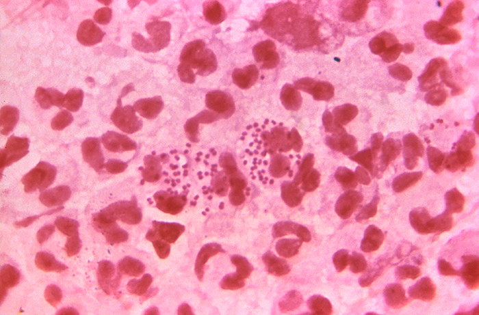 Gram-stained photomicrograph showing Neisseria gonorrhoeae diplococcal bacteria